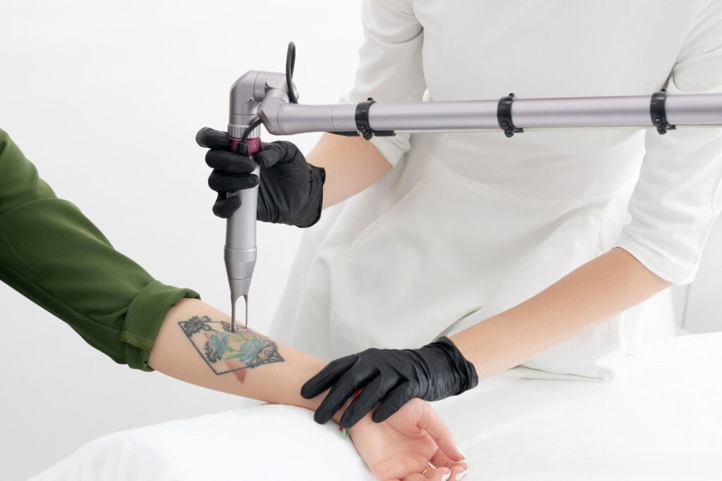 Modern laser tattoo removal treatment process