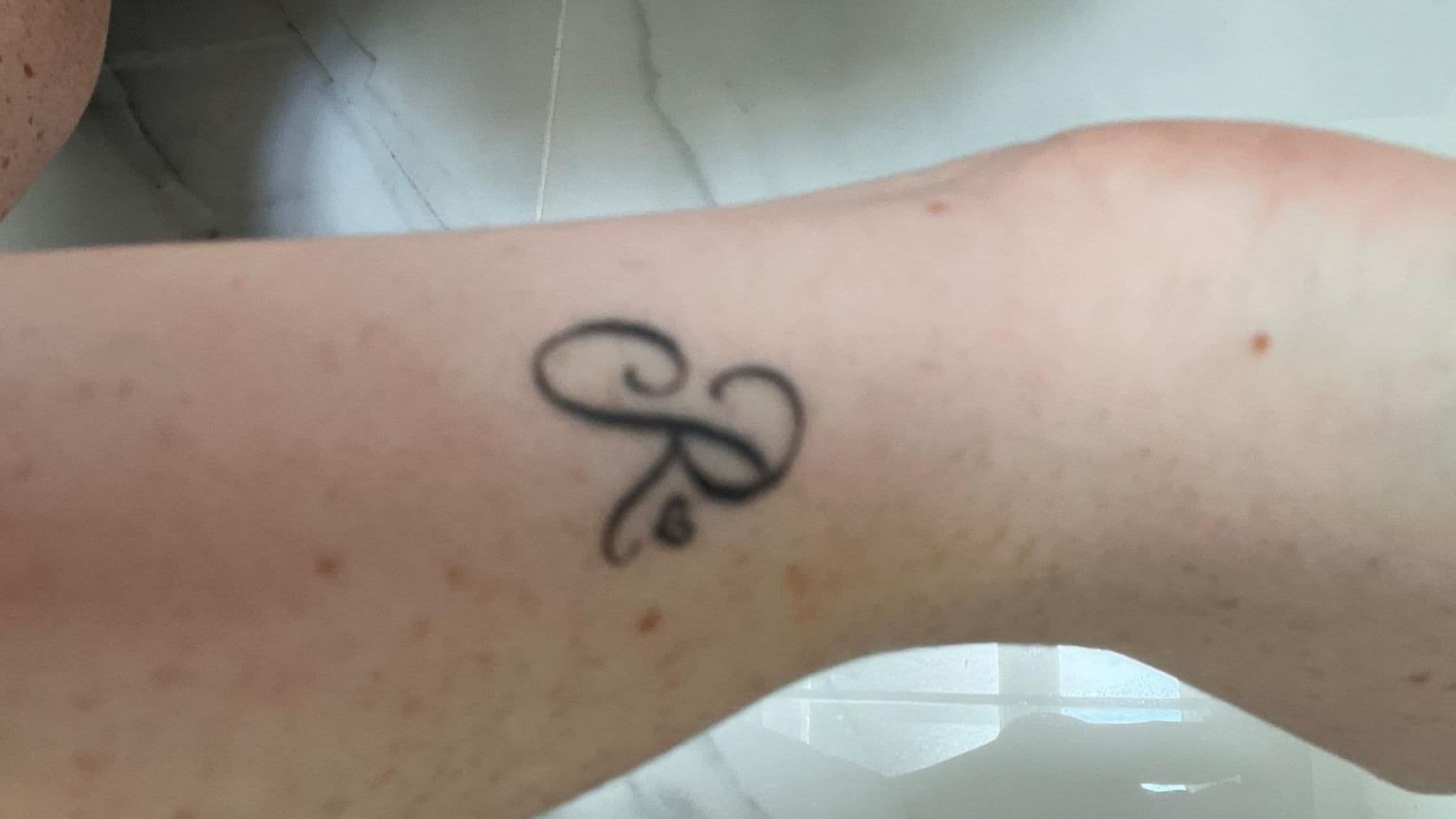 tattoo removal technologies